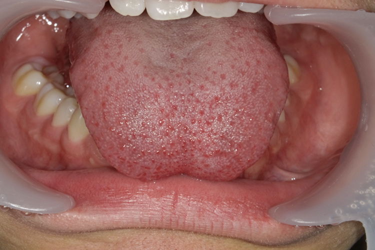 舌小帯手術 治療前