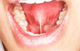 舌小帯手術