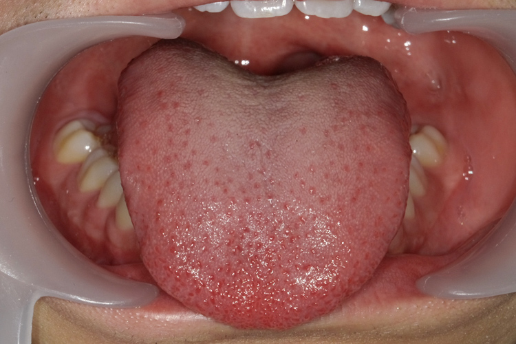 舌小帯手術 治療後