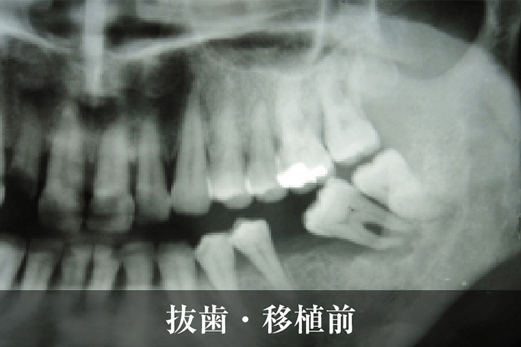 歯牙移植治療 抜歯・移植前