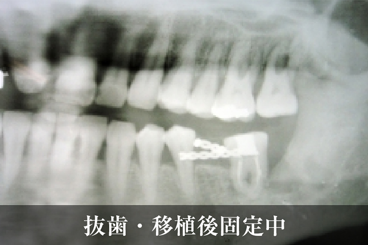 歯牙移植治療 抜歯・移植後固定中
